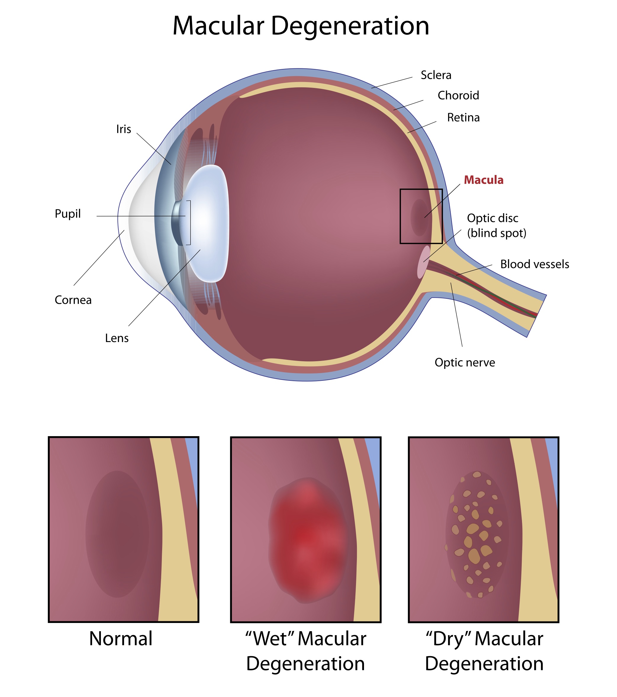 vision problems